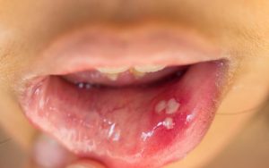 Jak leczyć wirusa brodawczaka w jamie ustnej na śluzówce?