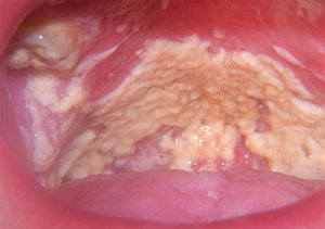 Кандидоза на устната кухина: причини, клиника, диагноза
