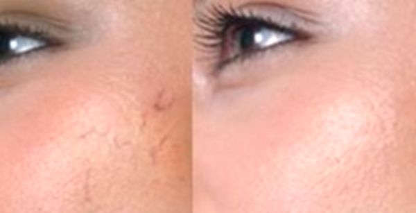 Prevenzione e trattamento della couperosi sul viso: rimedi popolari, cura del salone e cosmetologia dell'hardware