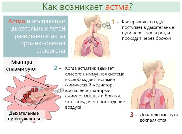 Astma oskrzelowa - leczenie ludowych środków zaradczych jest niebezpieczne