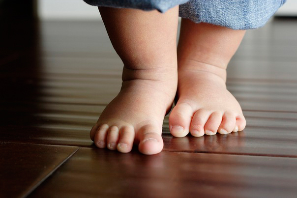 Trattamento delle deformità del piede piatto-valgo nei bambini