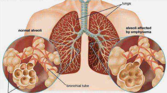Léčba obstruktivní bronchitidy lidových léků