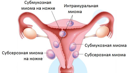 Hipertenzija miometrija u trudnoći: uzroci, liječenje, posljedice