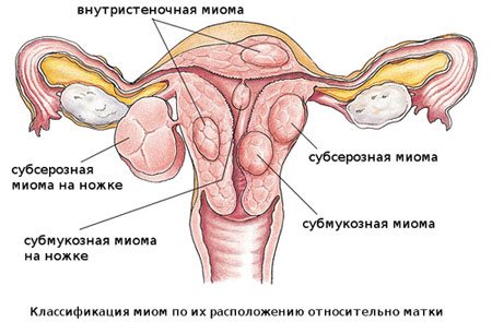 Pierwsze oznaki mięśniaków macicy, objawy i metody leczenia