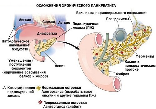 Pankreatická resekce postižení