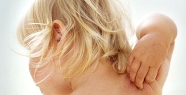 Atopični dermatitis pri otrocih: preventiva in nega