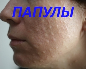 Поткожни внатрешни пупки на лицето: причини и третман