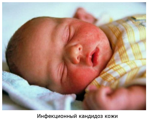 Млечница при новородени в устата: лечение