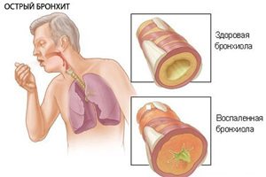 Cauze, simptome și tratamentul bronșitei acute