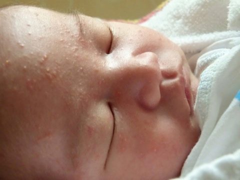 Akné na tváři novorozence
