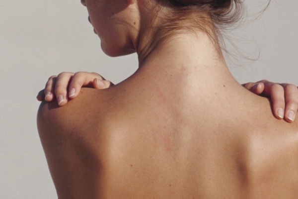 Akné na ramenou: příčiny