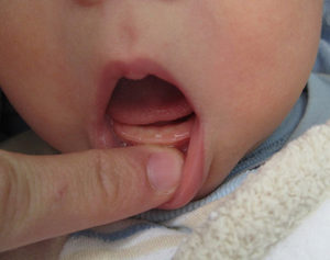 Bir çocukta diş çıkarma: nasıl hayatta kalınır, yollar ve ipuçları