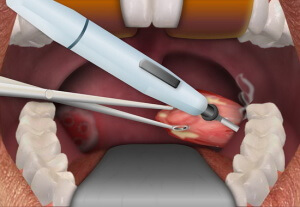 Tonsille ingrossate: rimozione o meno, indicazioni, metodi, recupero dopo la rimozione