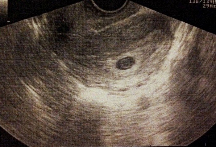 Ultrazvok v 5. tednu nosečnosti: velikost ploda in druge značilnosti