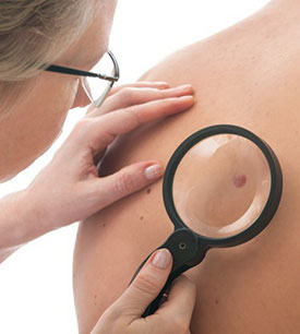 Šta je opasan rak kože