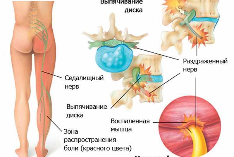 Sintomi e trattamento della sciatica - infiammazione del nervo sciatico