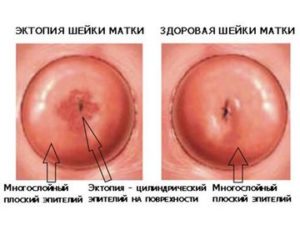 Ce este eroziunea cervicală congenitală