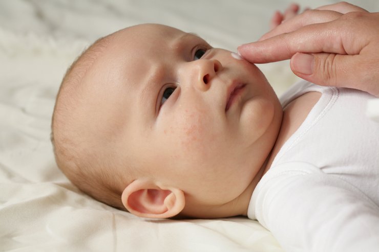 Dijateza kod beba: njeni simptomi i uzroci