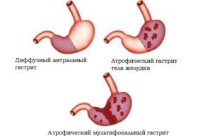 liječenje hipertenzije shevchenko osvrta