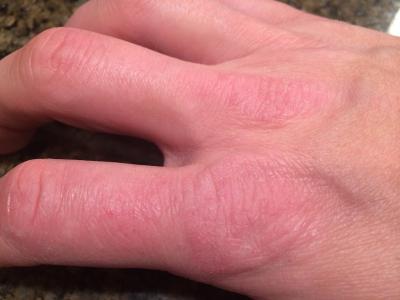 Cosa fare se la pelle delle mani è ruvida e secca