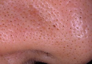 Acne sul naso: metodi di pulizia della pelle