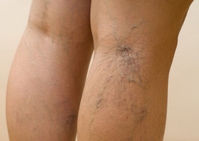 Proširene vene na nogama, simptomi i detaljne fotografije