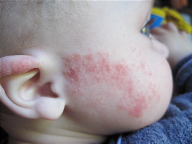 Види алергії у дітей
