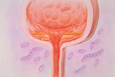 Inflamația vezicii urinare la femei: semne și tratament