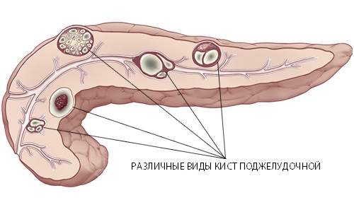 Bolečina pri pankreatitisu kot glavni simptom bolezni - zdravimo trebušno slinavko