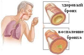 Yetişkinlerde kronik bronşit - belirtileri ve tedavisi, nedenleri, komplikasyonları