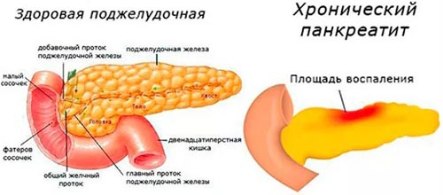 Pancreatite cronica - sintomi, cause, trattamento, dieta e esacerbazione negli adulti
